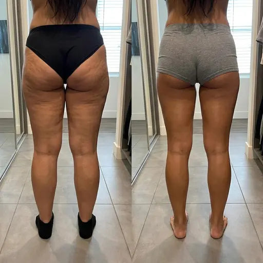 VenaLift™ — Masseur Anti-Cellulite 4-en -1