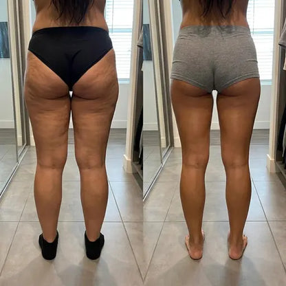 VenaLift™ — Masseur Anti-Cellulite 4-en -1